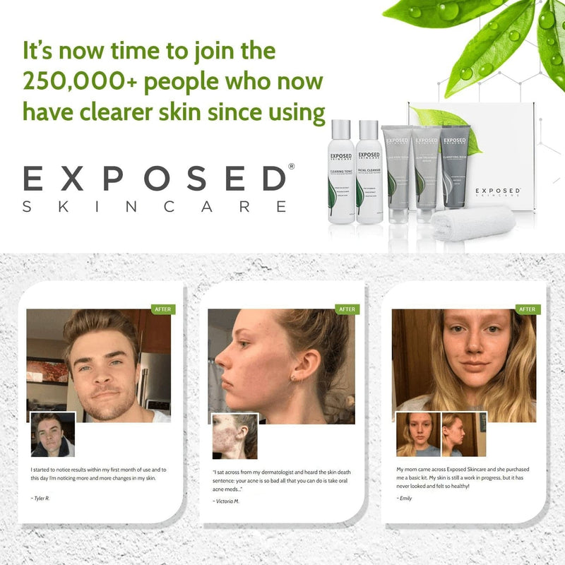 Exposed Skin Care Acne Treatment Kit - Includes Facial Cleanser, Clearing Tonic, Acne Treatment Serum, Clear Pore Serum, Clarifying Mask, Cloth - Natural Acne Solution for Face, All Ages & Skin Types - Premium  from Exposed Skin Care - Just $134.77! Shop now at Handbags Specialist Headquarter