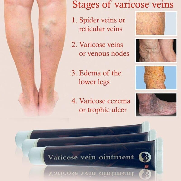 Varicose Veins Treatment Cream Effective cure Vasculitis Phlebitis Spider Veins Pain Varicosity Angiitis ointment Health Care - Premium 200367158 from BaBa Ali (Aliexpress) - Just $2.48! Shop now at Handbags Specialist Headquarter